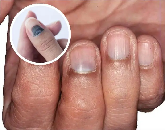 สะดุ้ง! 5 สัญญาณบนฝ่ามือที่เตือนว่า ป.อ.ด กำลังมีปัญหา