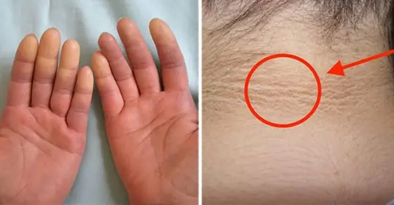7 สัญญาณบนผิวหนังที่บ่งบอกว่าเป็นเบาหวาน ระวังหากพบสิวผิดปกติ