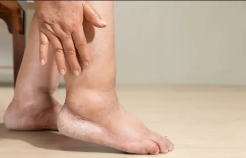 อยากรู้ตับแข็งแรงไหม? แค่ดูที่เท้า หากมีสัญญาณ 1 ใน 5 ข้อนี้ ควรไปตรวจสุขภาพ!