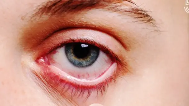 8 ผลเสียร้ายแรง! การขยี้ตาบ่อย ทำลายดวงตาและเร่งให้เกิดริ้วรอยก่อนวัย