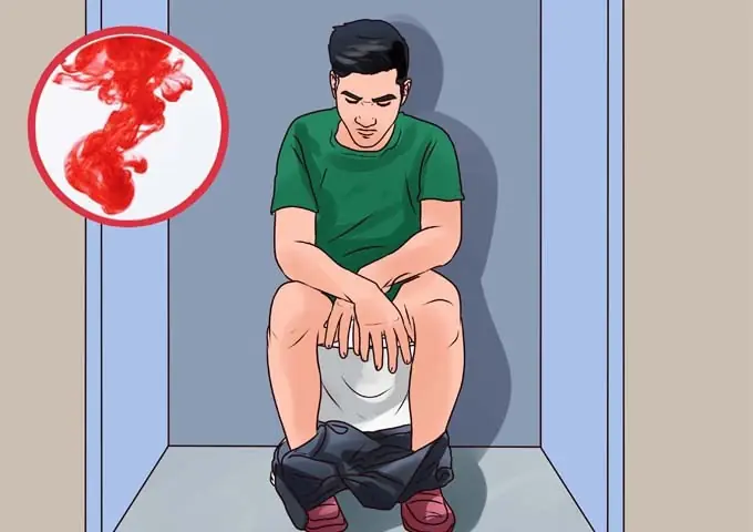 5 สัญญาณเตือน “มะเร็งลำไส้ใหญ่ระยะเริ่มต้น” รู้ทันก่อนสาย อาจช่วยชีวิตคุณได้