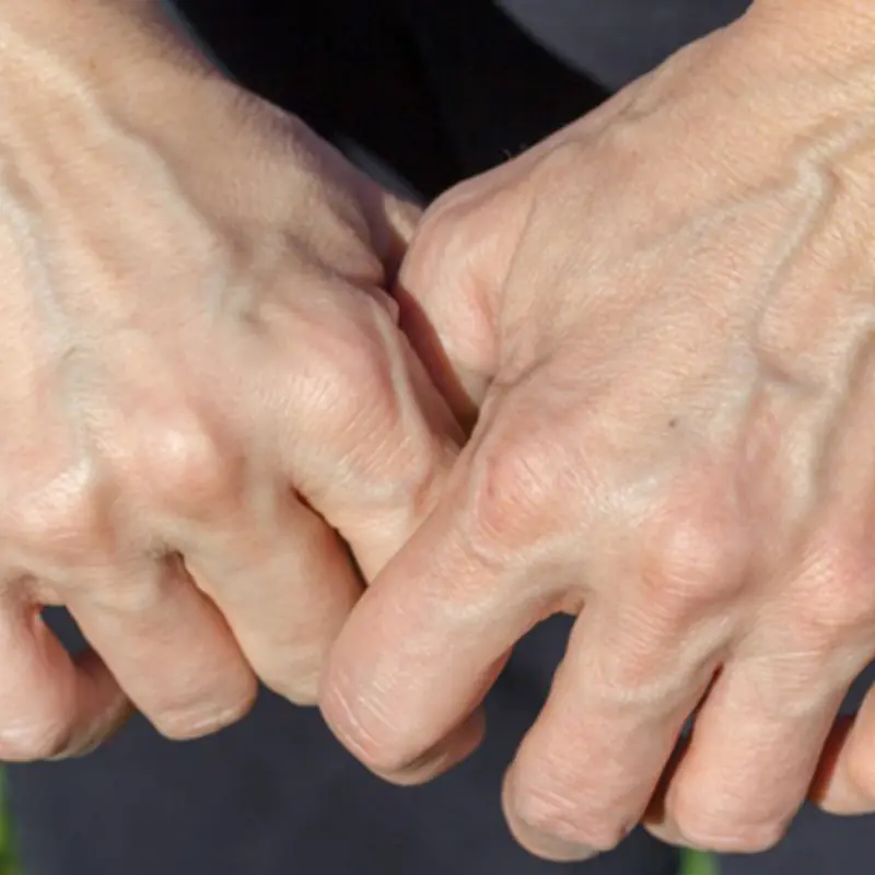 เส้นเลือดปูดบนมือหรือแขน... แค่ธรรมดาหรือสัญญาณเตือนสุขภาพกันแน่