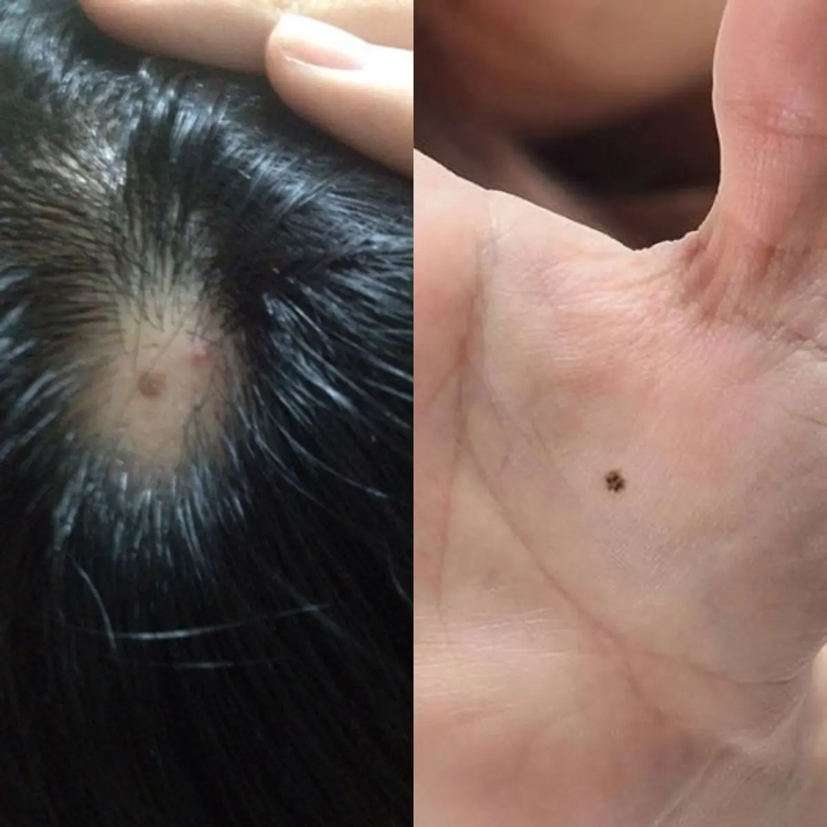 ตรวจเช็กทันที! ไฝขึ้นบนร่างกาย 6 ตำแหน่งนี้ สามารถ “กลายร่าง” เป็นม.ะ.เ.ร็.งได้ง่ายมาก