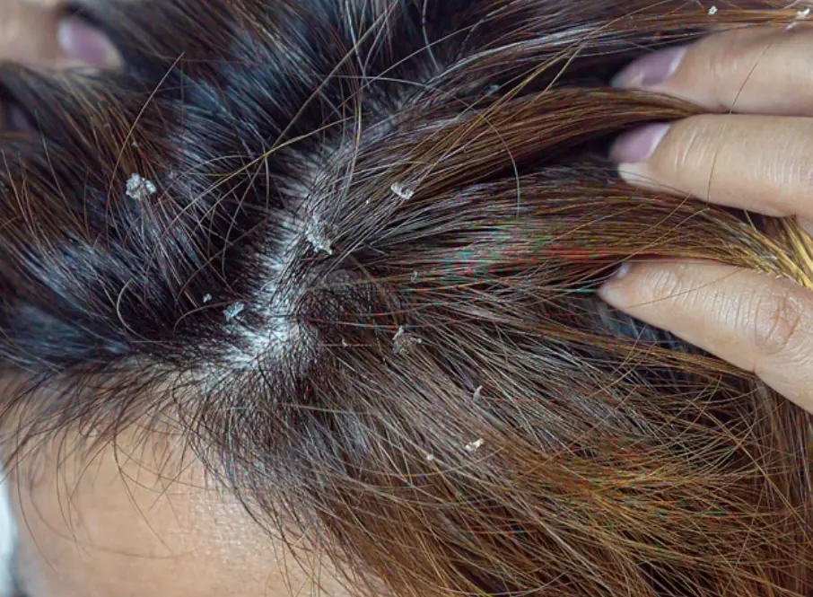 สัญญาณหนึ่งของ “โรคร้ายแรง” ที่มักถูกเข้าใจผิดว่าเป็น “รังแค” อย่ามองข้ามอีกต่อไป!