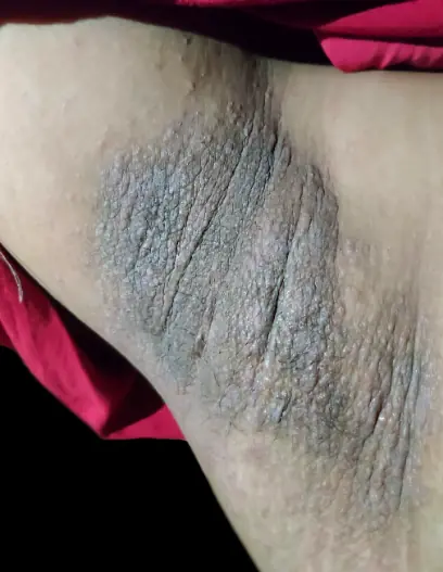 "รักแร้คาร์บอน" เกิดจากอะไร? ขัดให้ตายก็ไม่ออก แนะวิธีแก้ฟรีๆ ให้หาย