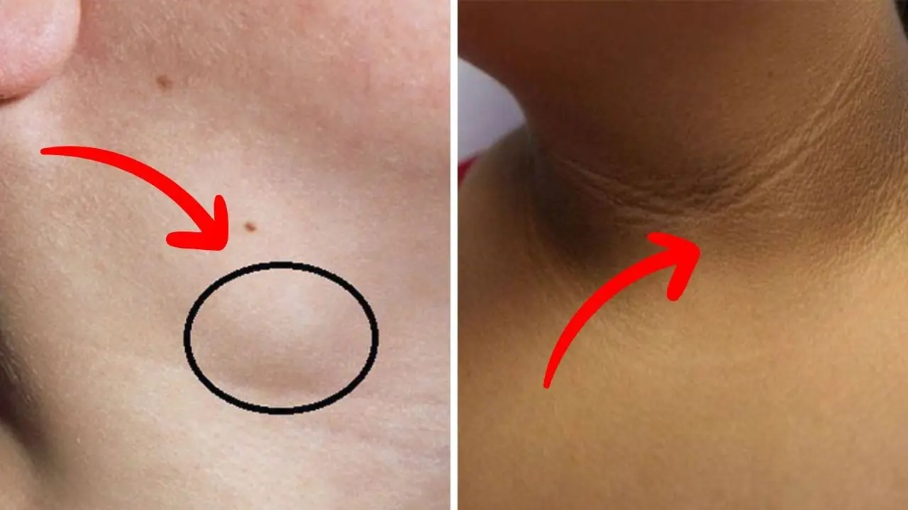 ผู้ที่กำลังเสี่ยงต่อโรคมะเร็ง มักมี 3 สัญญาณผิดปกติที่ลำคอ แค่มีข้อใดข้อหนึ่งก็เป็นสัญญา