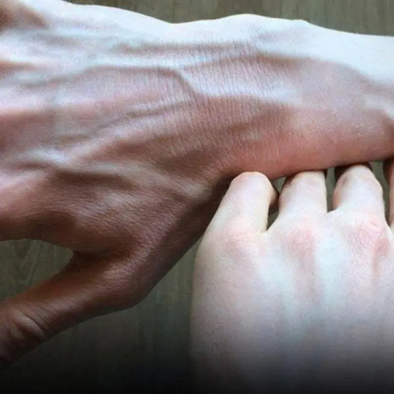 หากคุณเห็นใครมีเส้นเลือดโป่งพอง ควรรีบบอกพวกเขาเรื่องนี้ให้เร็วที่สุด!