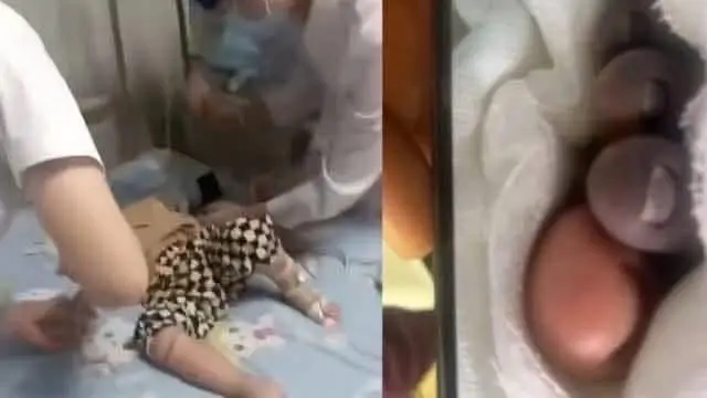 เด็กชายวัย 4 ขวบเสียชีวิตหลังจากกินไข่ต้ม ครอบครัวหลายบ้านยังคงประมาท