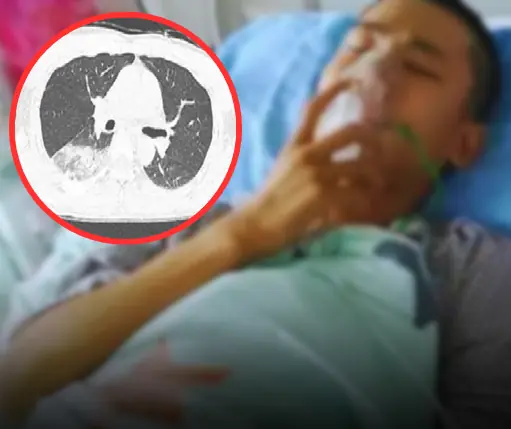 ชายวัย 46 ปีป่วยหนัก! ไข้สูงต่อเนื่อง 10 วัน ตับ-ไตเสียหาย เพราะ “งานอดิเรกเลี้ยงนก”