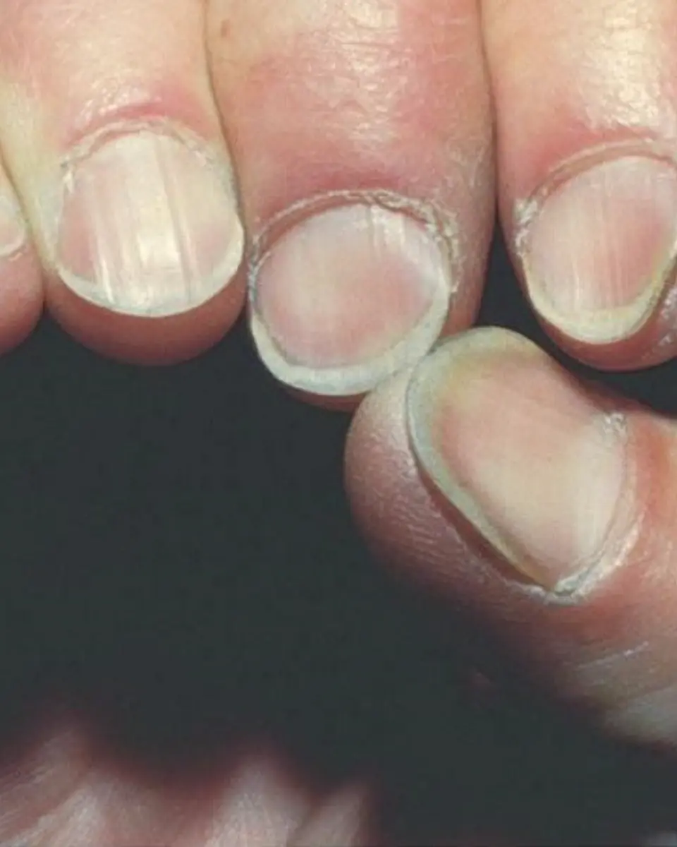 5 สัญญาณเตือนว่า “ตับของคุณ” อาจกำลังอยู่ในระยะอันตราย หากพบอาการเหล่านี้ ควรรีบไปพบแพทย์