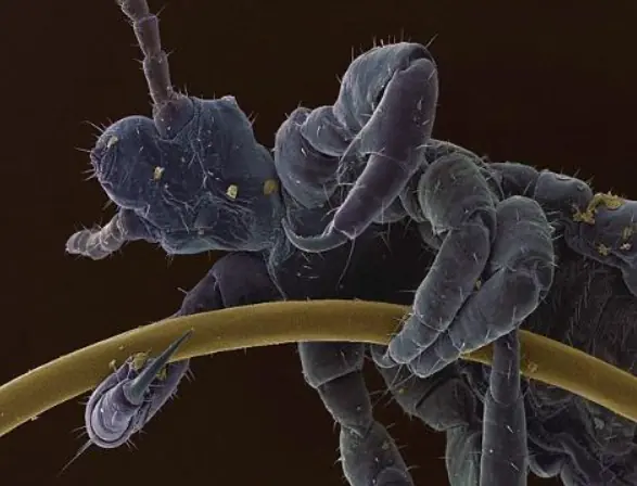 สิ่งที่เกาะอยู่บนหนังศีรษะของคุณ... อาจ “ซ่อนตัว” อยู่ตอนนี้โดยที่คุณไม่รู้ตัว!