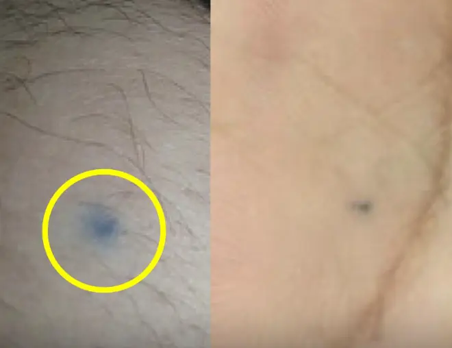 บาดแผลจาก “ดินสอ” ที่อาจทิ้งรอยถาวรบนผิวหนังโดยไม่รู้ตัว