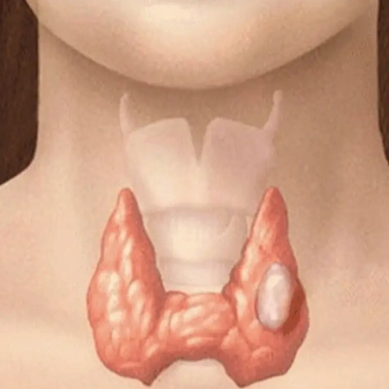 บล็อกสุขภาพ : “ต่อมไทรอยด์” เรื่องเล็กที่อาจกลายเป็นภัยใหญ่