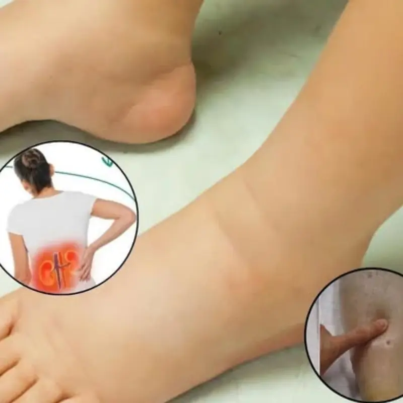 8 สัญญาณเตือน ภาวะไตวาย หากมองข้าม อาจต้อง ฟอกไตไปตลอดชีวิต