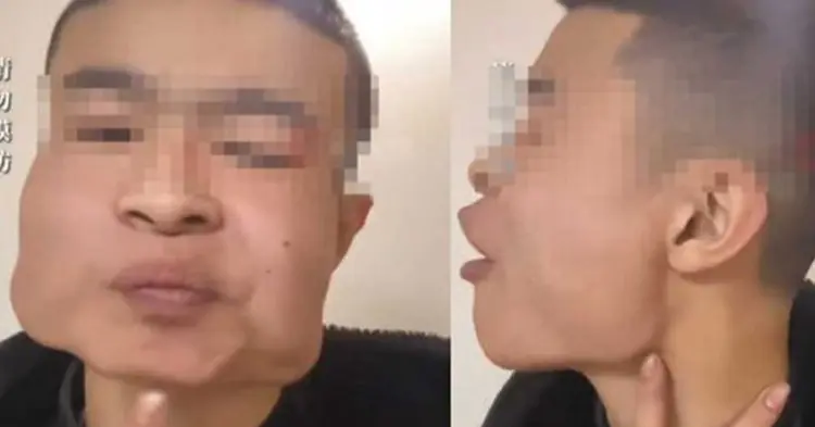 หนุ่ม 18 เคี้ยวหมากตั้งแต่ 10 ขวบ จนหน้าเปลี่ยน