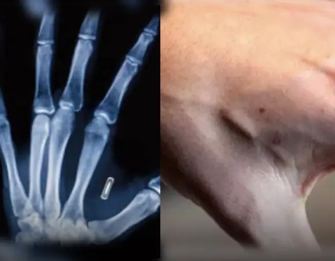 ผู้คนนับพันกำลังฝังไมโครชิปใต้ผิวหนังเพื่อใช้แทนกุญแจ บัตร และเอกสารส่วนตัว