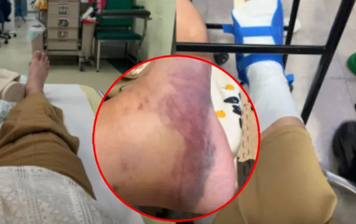 หมอเห็นยังดุ โตเป็นหนุ่มอายุ 22 ต้องให้แม่เปลี่ยนผ้าอ้อม เจ็บหนักเพราะใส่ "รองเท้าแตะ" ยอดน