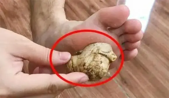 4 ประโยชน์ของการแปะขิงไว้ที่ฝ่าเท้าก่อนนอน