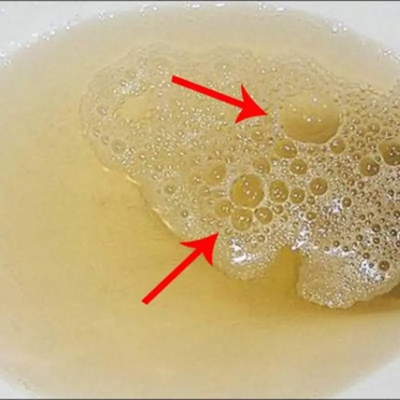 โรคไ.ตอาจทำให้ไ.ตเสื่อมถาวร! แพทย์เตือนอย่ามองข้าม 2 อาการเริ่มต้นนี้