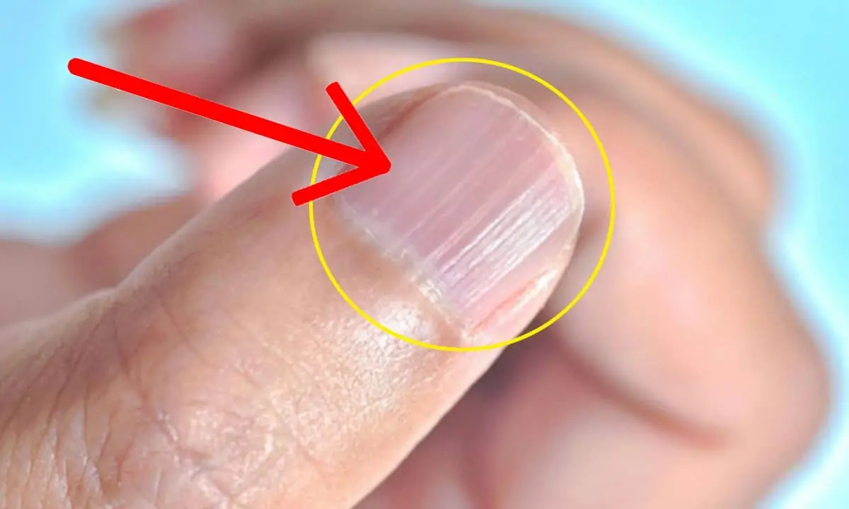 หากเส้นเหล่านี้เริ่มปรากฏบนเล็บของคุณหลังอายุ 40 ปี นั่นอาจเป็นสัญญาณสำคัญ…