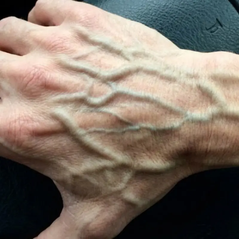 เห็นแล้วอย่ามองข้าม! ถ้าเจอคนเส้นเลือดปูด ต้องรีบบอกเรื่องนี้