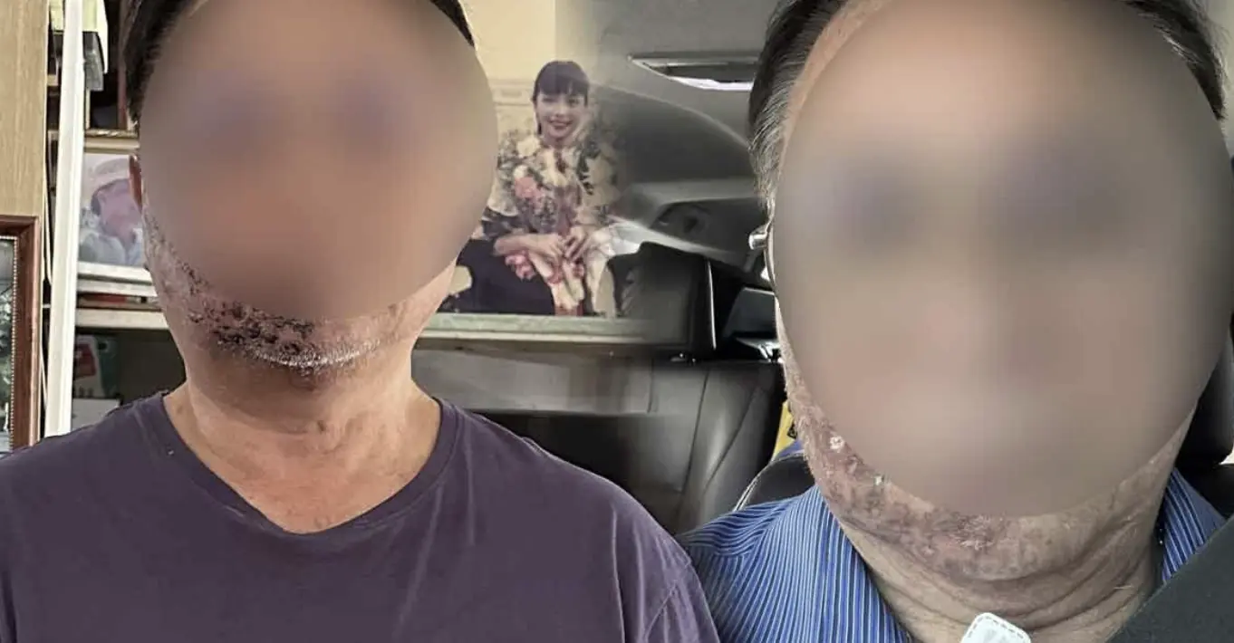 แชร์ประสบการณ์ป่วย งูสวัด ที่ใบหน้า เสียค่ารักษาเฉียด 1 ล้านบาท เตือนผู้สูงอายุฉีดวัคซีนป