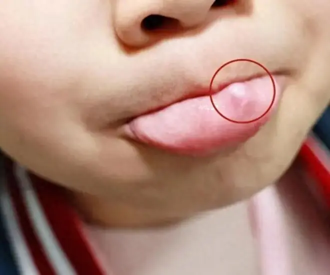 แม่ช็อก! พบก้อนเนื้อผิดปกติในปากลูก พาไปโรงพยาบาล แพทย์ตำหนิแรง: เกิดจากพฤติกรรมนี้ที่ทำเ