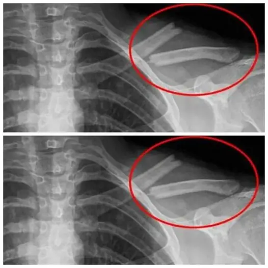 เครื่องดื่มนี้ทำลายกระดูก แต่หลายคนยังดื่มมันทุกวัน