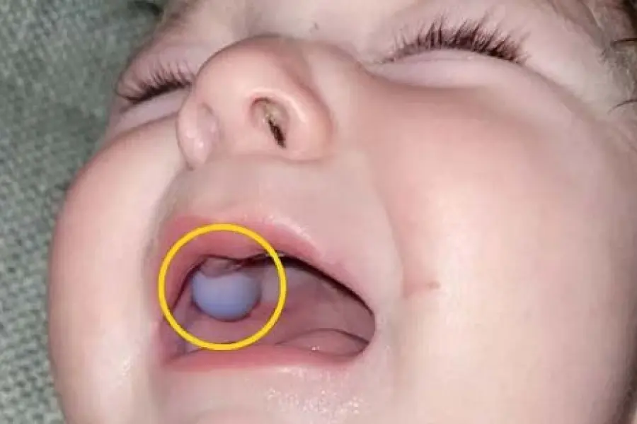 ช็อกทั้งห้องตรวจ! หมอคิดว่าเด็กมีเนื้องอกในปาก ก่อนรู้ความจริงที่แม่แทบทรุด