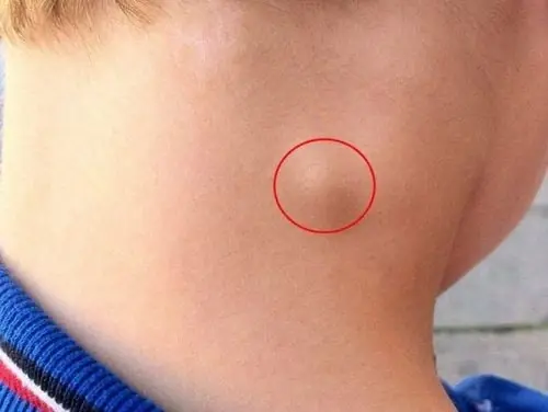 ผู้ที่เสี่ยงเป็นมะเร็ง มักมีสัญญาณผิดปกติ 3 อย่างที่บริเวณลำคอ แค่พบเพียงข้อเดียวก็ถือเป