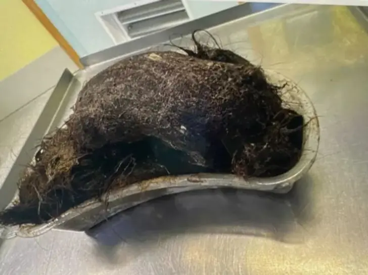 ลูกสาววัย 14 บ่นปวดท้องอยู่ครึ่งปี แม่สุดช็อก เมื่อเห็นสิ่งที่หมอผ่าออกจากกระเพาะ