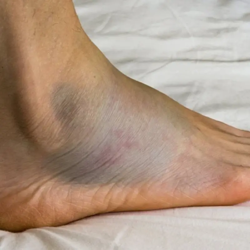 ขาบวม มือบวม ไม่ใช่เรื่องเล็ก! สัญญาณเตือนโรคที่ร่างกายกำลังส่งเสียงขอความช่วยเหลือ