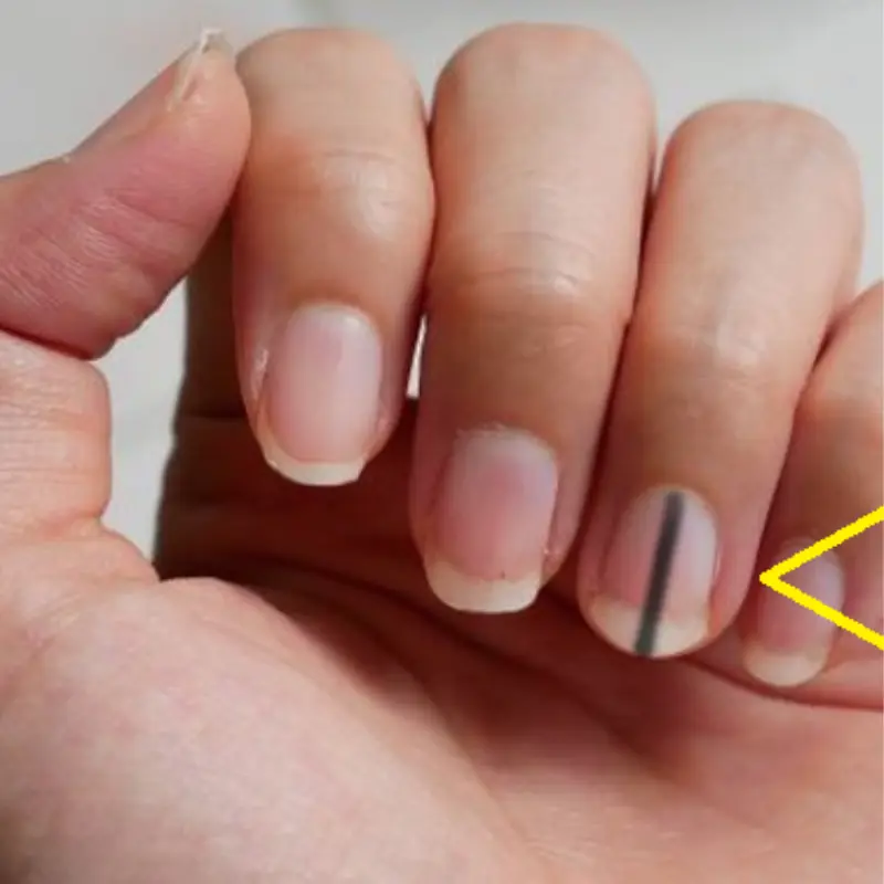 เช็กตัวเองด่วน! 5 จุดดำคล้ำที่อาจบอกความเสี่ยงมะเร็งโดยไม่รู้ตัว