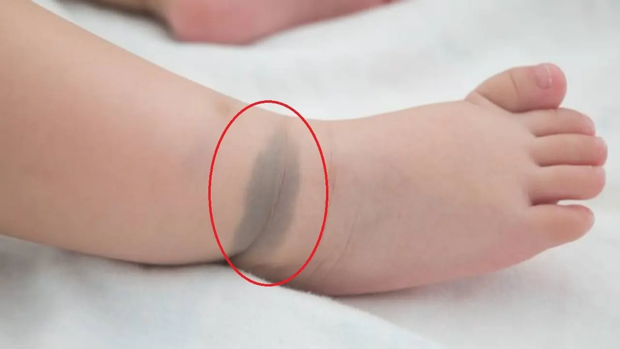 เด็กแทบทุกคนเมื่อแรกเกิดมักจะมีปานติดตัว แต่หากปรากฏใน 10 ตำแหน่งต่อไปนี้ ถือเป็นสัญญาณบ่