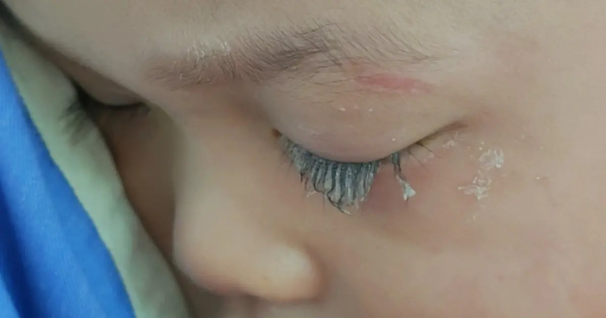 ลูกชายเผลอทำกาว 502 เข้าตา คุณพ่อไหวพริบดีหยดสิ่งนี้ช่วยลูก ผลลัพธ์น่าทึ่งเกินคาด