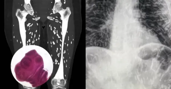 พยาธิไปสร้างรังอยู่ทั่วร่างกาย สาเหตุเพราะวิธีปรุงเนื้อหมูแบบนี้ ที่หลายคนชอบทำกันบ่อย