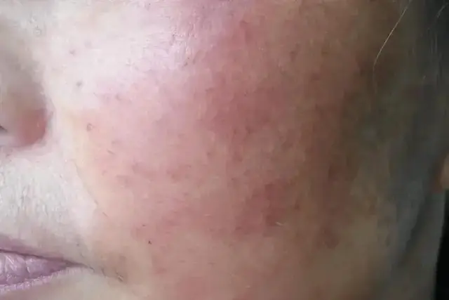 ผู้หญิงคนหนึ่งถูกวินิจฉัยว่าเป็นมะเร็งผิวหนัง นิสัยการอาบน้ำของหลายคนอาจเป็นสาเหตุ