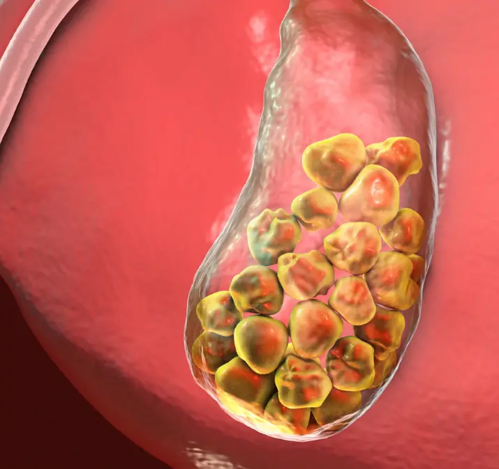 นิ่วเต็มถุงน้ำดี! แพทย์เตือน “กินไข่ทุกวัน” หากพลาดสิ่งนี้ อาจเสี่ยงโดยไม่รู้ตัว