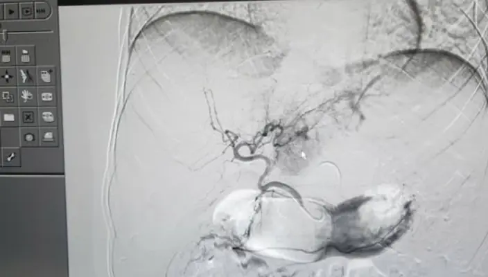 ชายวัย 31 ปีเข้ารับการรักษาด่วนหลังเกิดเหตุไม่คาดคิดภายในร่างกาย