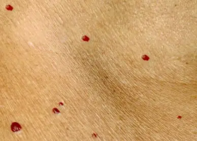 ถ้าคุณเคยสังเกตเห็น “จุดแดง” บนร่างกาย นั่นอาจหมายความว่า…