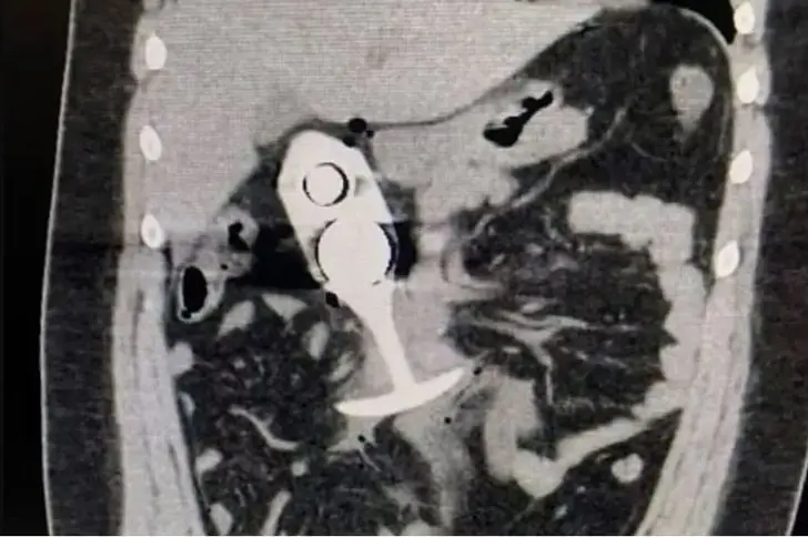 อุทาหรณ์สยอง! สาวเข้าเครื่อง MRI พลาดมี "อุปกรณ์โลหะ" ในร่าง ถูกแรงดูดมหาศาล เกือบไม่รอด