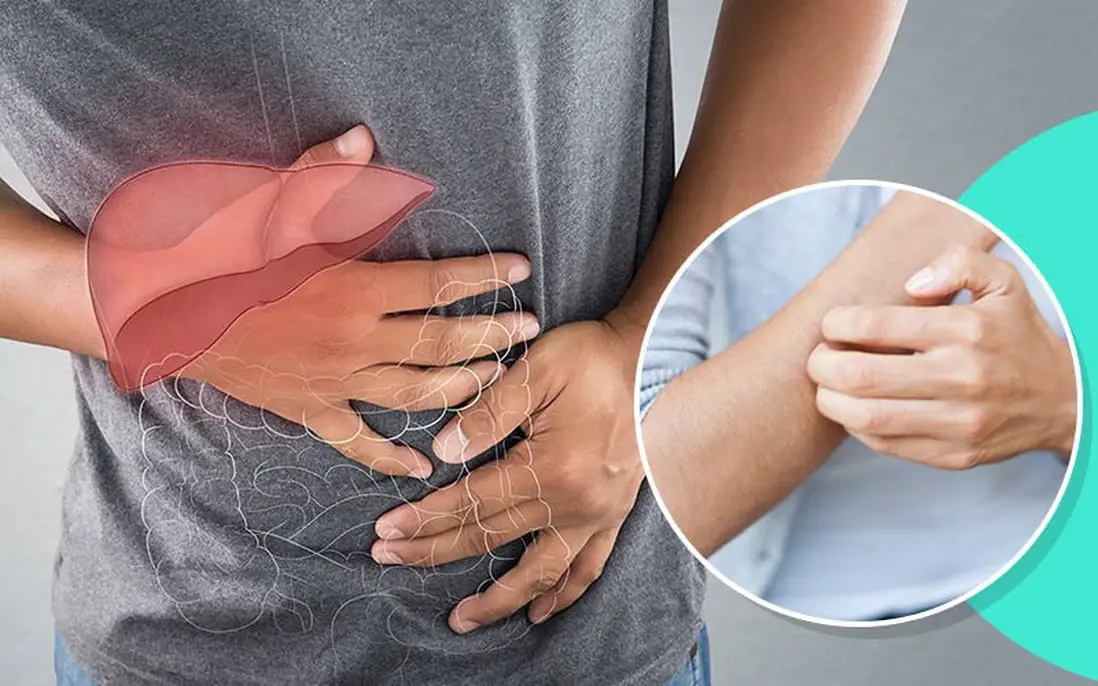 4 อาการคันจากมะเร็งตับ ที่มักถูกเข้าใจผิดว่าเป็นผิวหนังอักเสบจากภูมิแพ้