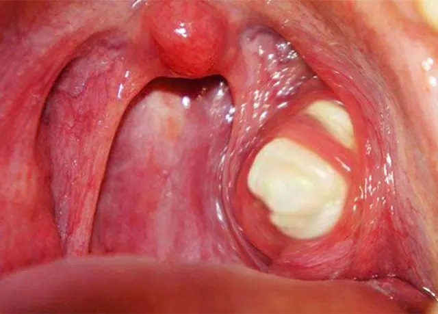 สาววัย 20 ถูกแฟนบอกเลิกเพราะ “กลิ่นปากแรง” ไปตรวจถึงรู้ว่าเป็นก้อนนิ่วในทอนซิล!