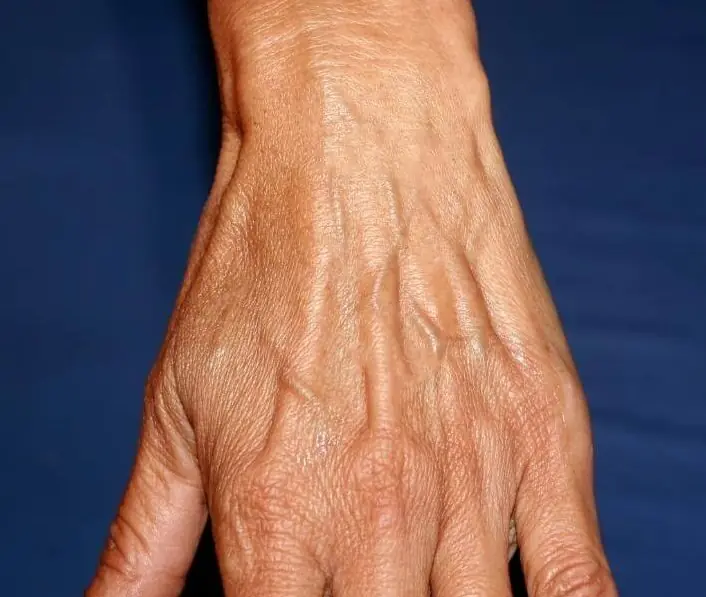 ถ้าเส้นเลือดบนมือของคุณเห็นชัด นั่นอาจเป็นสัญญาณบางอย่างที่ร่างกายกำลังบอกคุณ