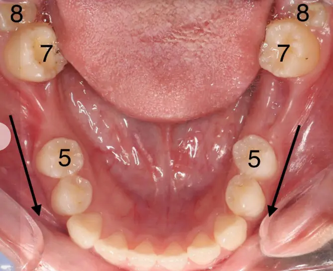 เคล็ดลับที่หลายคนไม่รู้! ทำไมฟันซี่ที่ 5 และ 7 ถึงขยับเข้าหากันเอง