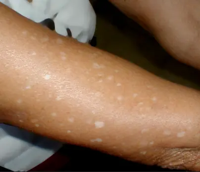 จุดขาวเล็ก ๆ บนผิวหนัง เกิดจากอะไร และอันตรายหรือไม่?