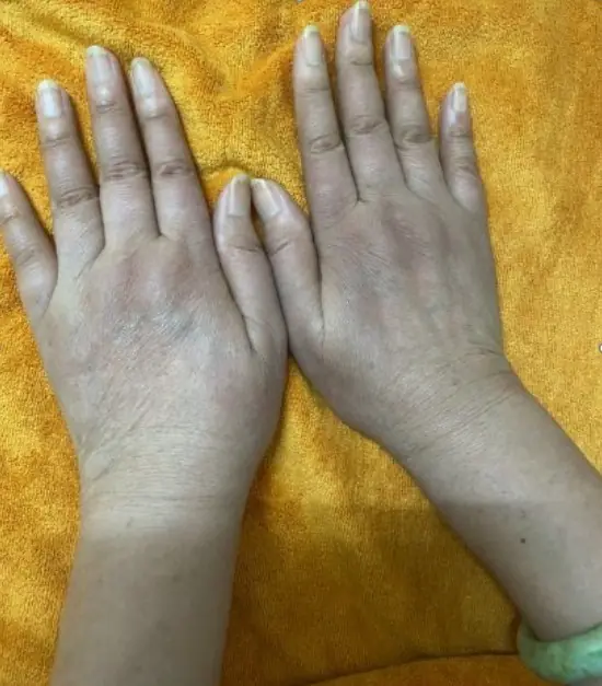 ผู้หญิงรายหนึ่งมีสัญญ.าณผิ.ดป.กติที่มือมานานหลายปี: เมื่อไปพบแพ.ทย์ พบว่าร่าง.กายกำลัง “เผช