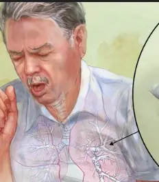 ทำไมลำคอถึงมีเสมหะเหนียวตลอดเวลา? เปิดความจริงที่หลายคนมองข้าม