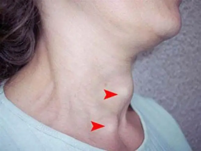 หลีกเลี่ยงอาหาร 6 ชนิดนี้ ที่อาจเป็นอันตรายต่อสุขภาพต่อมไทรอยด์ของคุณ