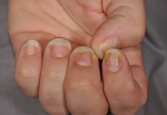 ตับพัง-หัวใจวาย! เตือนเช็ก "เล็บ" ด่วน สัญญาณร้ายที่หมอสั่งห้ามมองข้าม